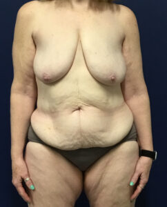 Abdominoplasty-Case--7412 | Before Tummy Tuck 1