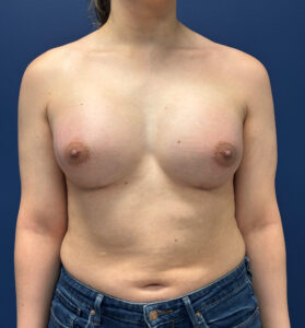 Breast-Augmentation-Case--2719 | After Dr. Frank Albino 1