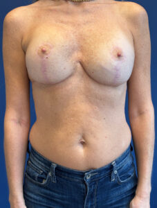 Breast-Reconstruction-Case--8978 | After Breast Reconstruction 1