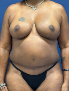 Breast-Reduction-Case--4053 | After Breast Reduction 1