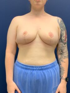 Breast-Reduction-Case--2527 | After Breast Reduction 1