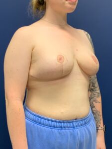 Breast-Reduction-Case--2527 | After Breast Reduction 2