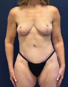 Abdominoplasty-Case--7412 | After Tummy Tuck 1