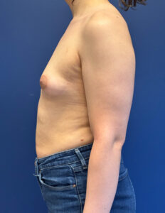 Breast-Augmentation-Case--2719 | Before Dr. Frank Albino 2