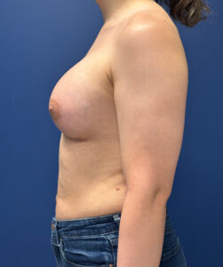 Breast-Augmentation-Case--2719 | After Dr. Frank Albino 2