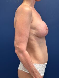 Augmentation-Mastopexy-Case--7491 | After Dr. Arjun Kanuri 2