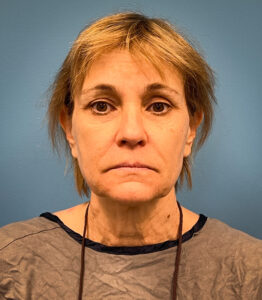 Facelift-Case--8739 | Before Facelift 1