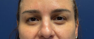 Blepharoplasty-Case--5118 | Before Dr. Arjun Kanuri 1