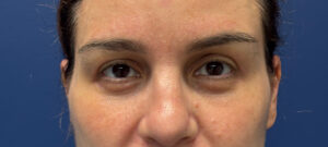 Blepharoplasty-Case--5118 | After Dr. Arjun Kanuri 1