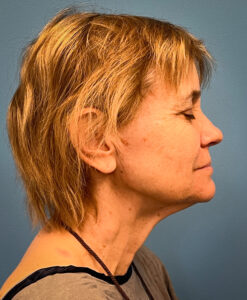 Facelift-Case--8739 | Before Facelift 2