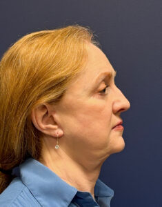 Facial-Fat-Grafting-Case--3549 | After Facial Fat Grafting 2