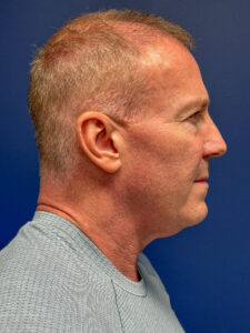 Facelift-Case--5246 | Before Facelift 2