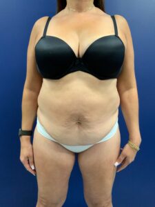 Abdominoplasty-Case--21804 | Before Tummy Tuck 1