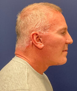 Facelift-Case--5246 | After Facelift 2