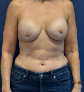 Breast-Reconstruction-Case--4864 | Before Breast Reconstruction 1