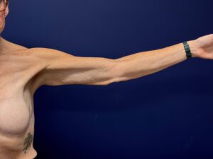 Brachioplasty-Case--3898 | After Body 2