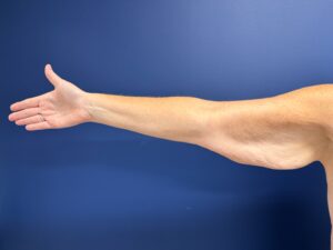 Brachioplasty-Case--3898 | Before Body 1