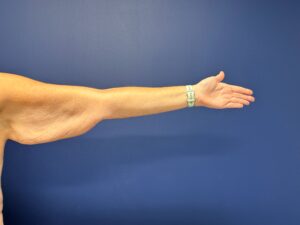 Brachioplasty-Case--3898 | Before Body 2