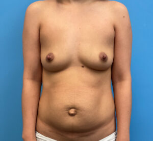 Breast-Augmentation-Case--4098 | Before Dr. Frank Albino 1