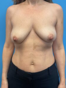 Breast-Reconstruction-Case--6069 | Before Breast Reconstruction 1