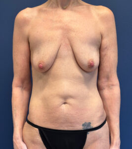 Augmentation-Mastopexy-Case--7491 | Before Dr. Arjun Kanuri 1