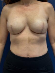Breast-Reconstruction-Case--6069 | After Breast Reconstruction 1