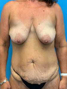 Abdominoplasty-Case--7038 | Before Tummy Tuck 1