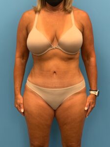 Abdominoplasty-Case--7924 | After Tummy Tuck 1