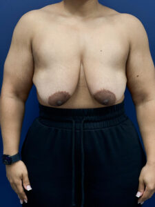 Breast-Reduction-Case--7345 | Before Breast Reduction 1