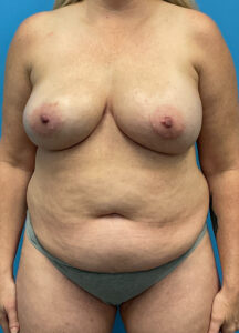 DIEP-Flap-Case--2056 | Before DIEP Flap 1