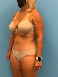 Abdominoplasty-Case--7924 | After Tummy Tuck 2
