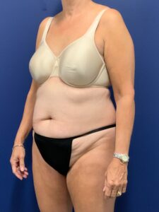 Abdominoplasty-Case--7963 | Before Tummy Tuck 2