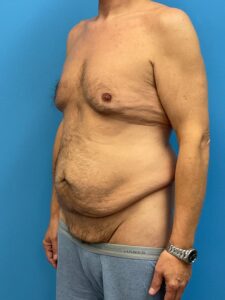 Abdominoplasty-Case--2524 | Before Tummy Tuck 2