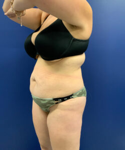 Abdominoplasty-Case--3073 | Before Tummy Tuck 2