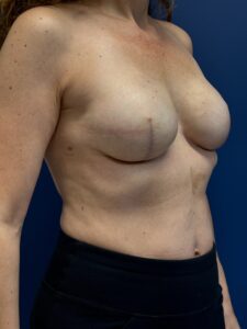 Breast-Reconstruction-Case--6069 | After Breast Reconstruction 2