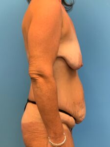 Abdominoplasty-Case--7009 | Before Tummy Tuck 2