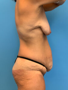 Abdominoplasty-Case--7038 | Before Tummy Tuck 2