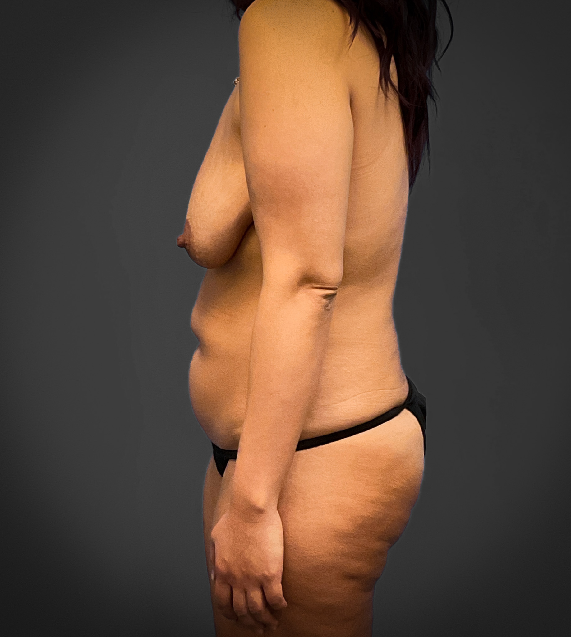 Lipoabdominoplasty-Case--7989 | Before Liposuction 2