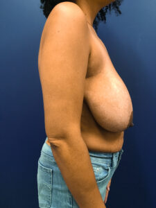 Breast-Reduction-Case--4484 | Before Breast Reduction 2