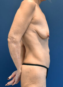 Augmentation-Mastopexy-Case--7491 | Before Dr. Arjun Kanuri 2