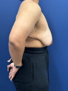 Breast-Reduction-Case--7345 | After Breast Reduction 1